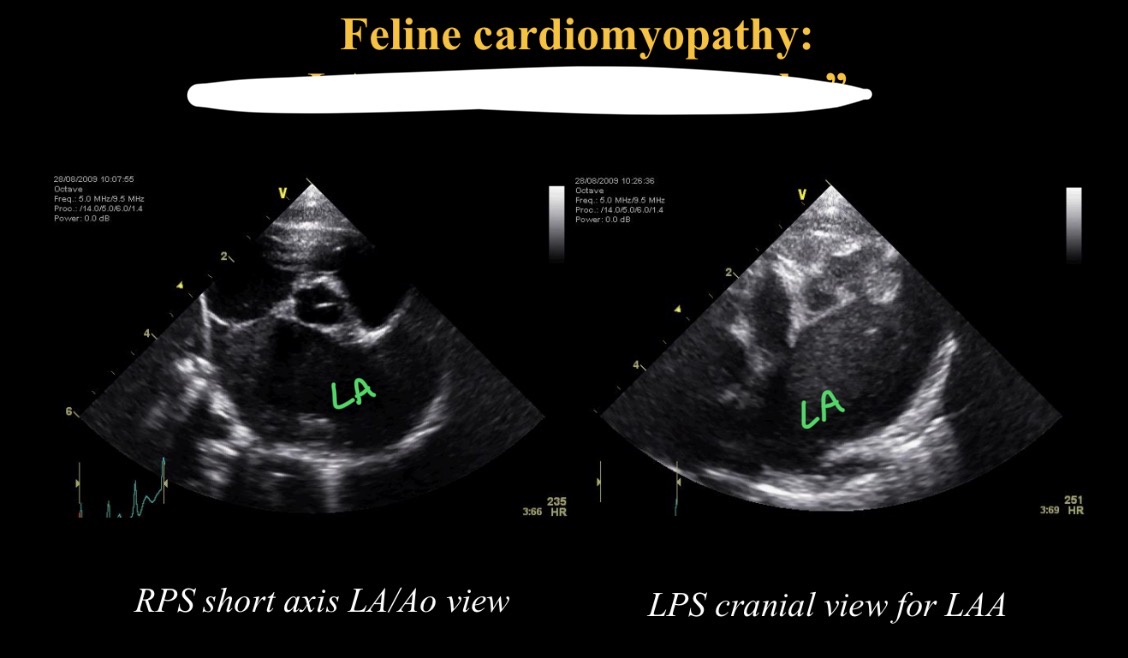 <p>Saddle thrombi → LA thrombus (smoke)</p>
