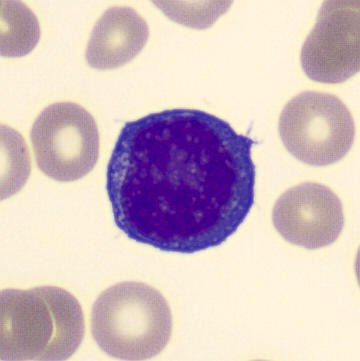 <ul><li><p>size: 16 micrometers</p></li><li><p>NC ratio: 6:1 (large nucleus)</p></li><li><p>cytoplasm: blue, with areas of clearing</p></li></ul><p></p>