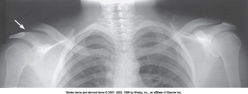 <p>What articulation is demonstrated</p>