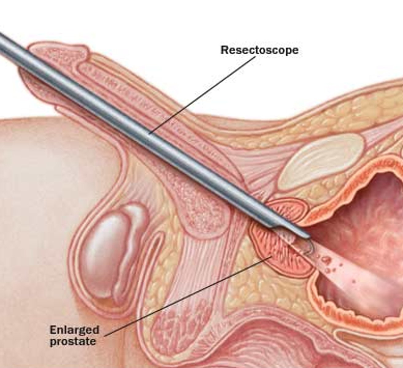 <p>excision of the prostate gland</p>