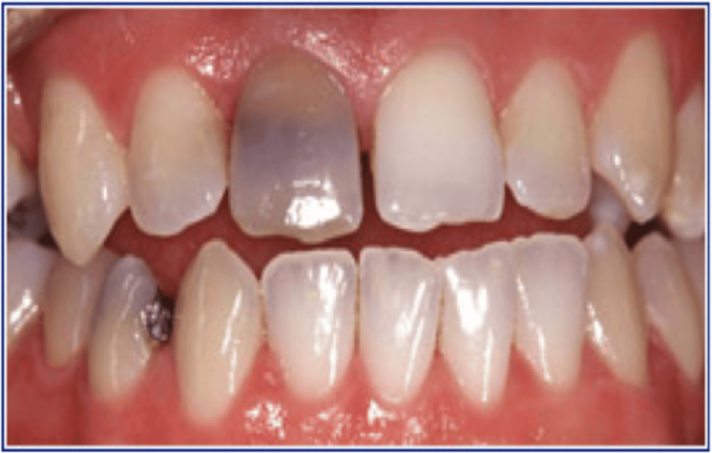 <p>Staining that may occur from enlarged pulp chamber or trauma</p><p>Dentin is darkened</p>