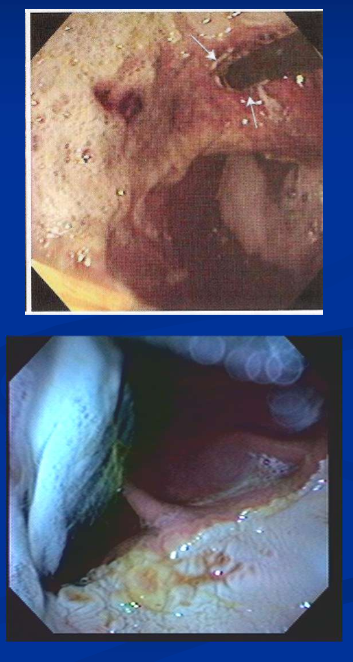 <ul><li><p>top: mild hyperkeratosis of squamous mucosa adjacent to margo plicatus, indicating mild erosive disease (gastrophilus larvae are observed on the adjacent glandular mucosa) </p></li><li><p>below: extensive erosion of squamous mucosa with sloughing of epithelium </p></li><li><p>top: severe diffuse squamous ulceration involving lesser curvature </p></li><li><p>below: thickened, hyperkeratotic appearance of deep, focal squamous ulcers in the chronic phase </p></li></ul><p></p>