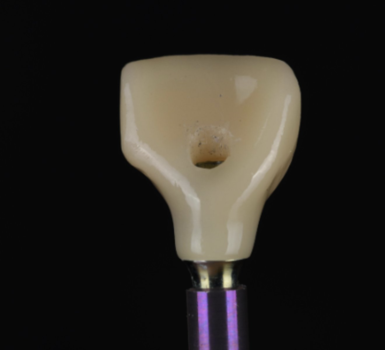 <p>Based on the figure provided, please select the correct sentences. (Select one answer).</p><p>a. This abutment is custom abutment</p><p>b. This restoration is screw retained implant restoration</p><p>c. This restoration is cement retained implant restoration</p><p>d .This is Metal ceramic restoration</p>