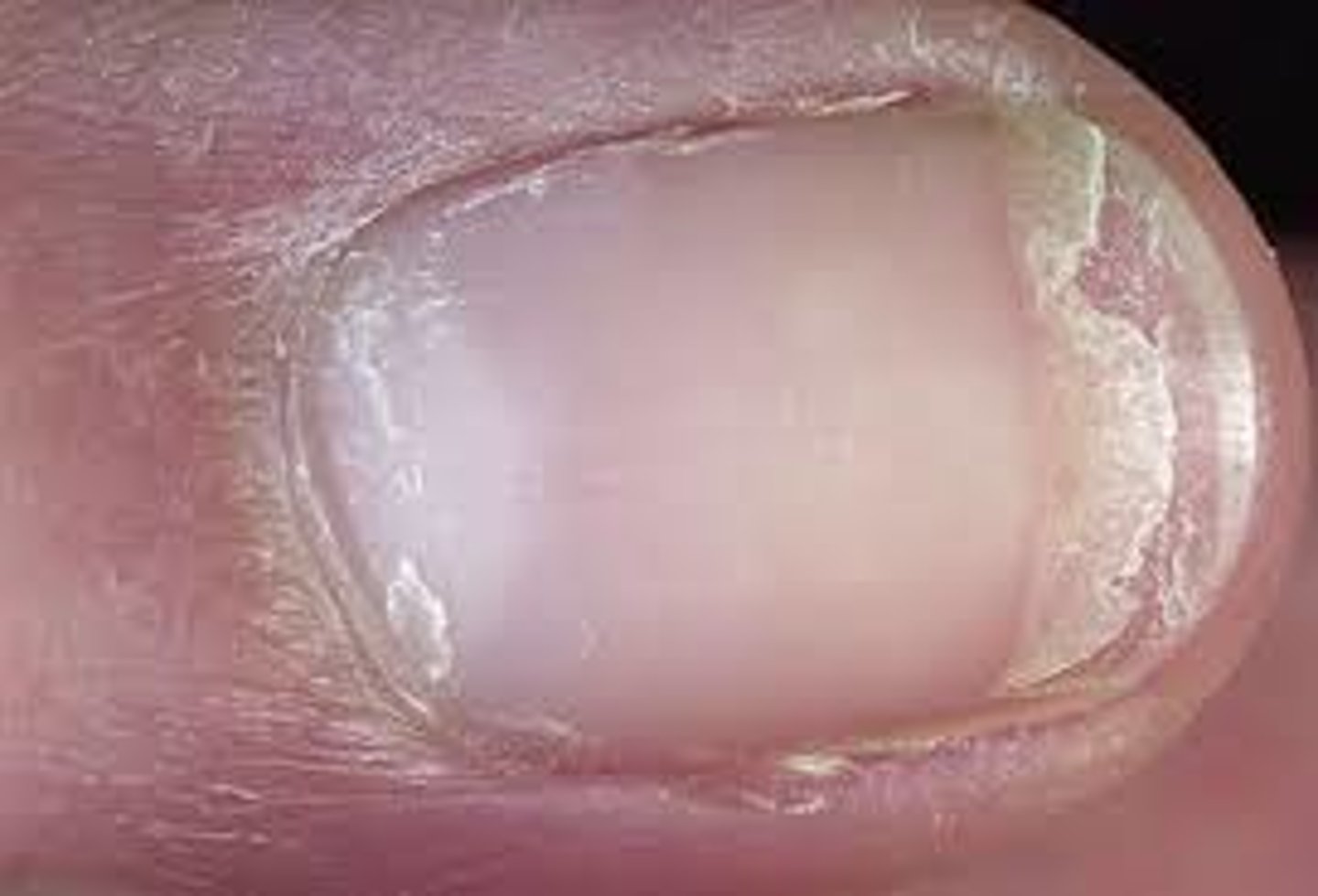 <p>splitting or lamination of the nail plate into layers that flake off</p>