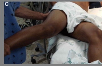 <p><span>is&nbsp;</span><strong>elicited by having the patient lie on his or her left side while the right thigh is flexed backward</strong><span>. Pain may indicate an inflamed appendix overlying the psoas muscle.</span></p>