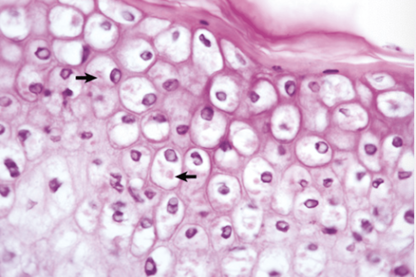<p>What type of acute cell swelling is being shown in this image?</p><p>1. Cytoxic edema</p><p>2. Balloning degernation</p><p>3. Hydropic degeneration</p>
