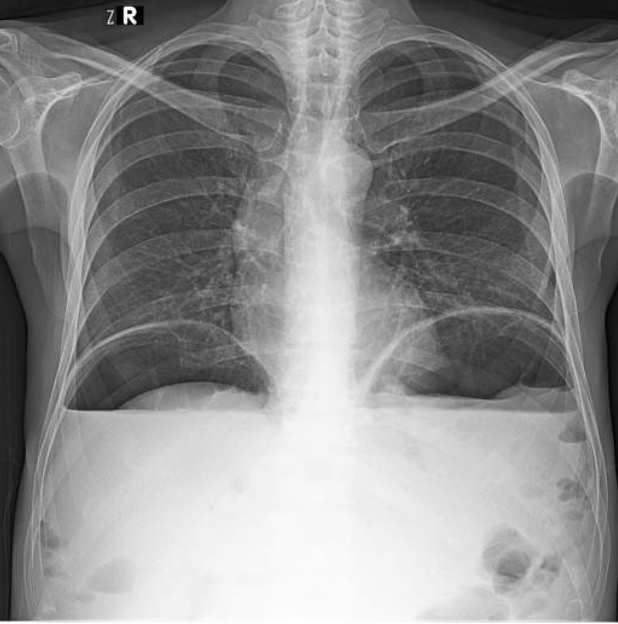 <p><span><strong><span>What do you think that free air under the diaphragm might indicate?</span></strong></span></p>