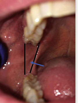 <ul><li><p>extends from junction of hard and soft palates down to the mandible on each side just posterior to most distal mandibular molar </p></li><li><p>stretches when patient opens mouth wider</p></li></ul><p></p>