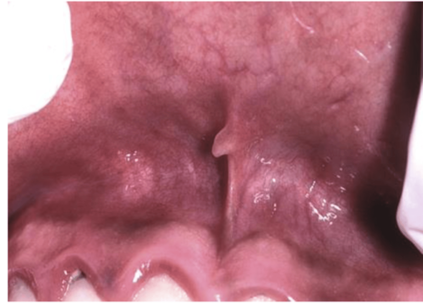 <p>• Fibrous hyperplasia</p><p>• Most common on the maxillary</p><p>labial frenum</p><p>• Small, asymptomatic, exophytic</p><p>growths</p><p>• Can be diagnosed clinically so no</p><p>treatment is necessary</p>