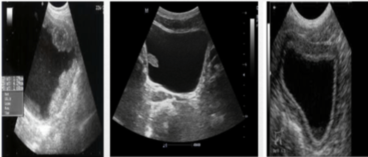 <p>suprapubic US</p>