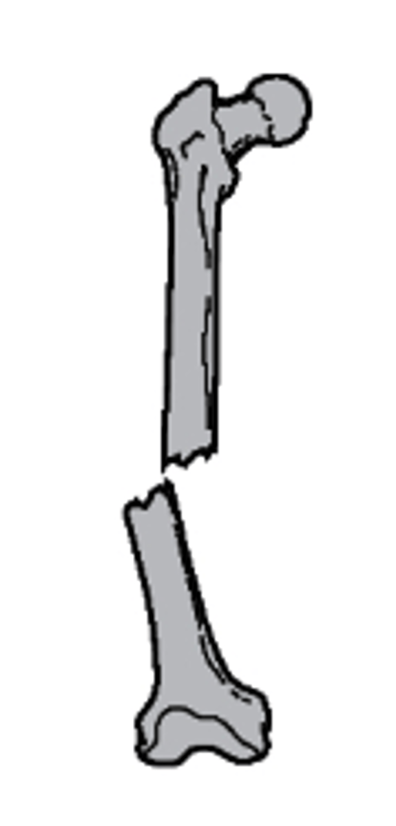 <p>what type of alignment is seen with this fracture?</p><p>a. nondisplaced</p><p>b. medial displacement</p><p>c. lateral displacement</p><p>d. distracted</p>