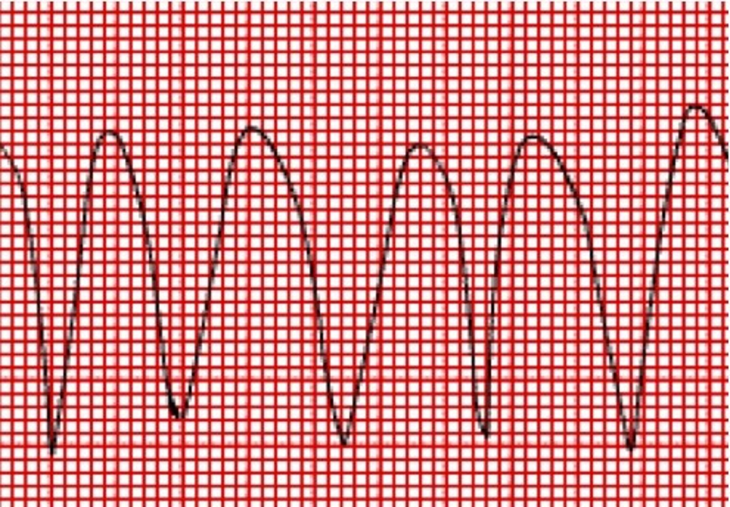 <p>Wide QRS with no P-wave</p>