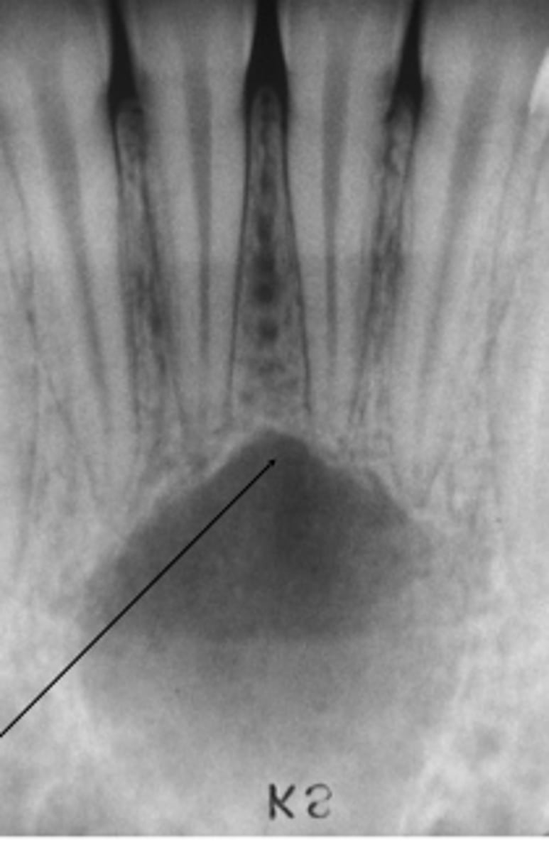 <p>What is a simple bone cyst?</p>