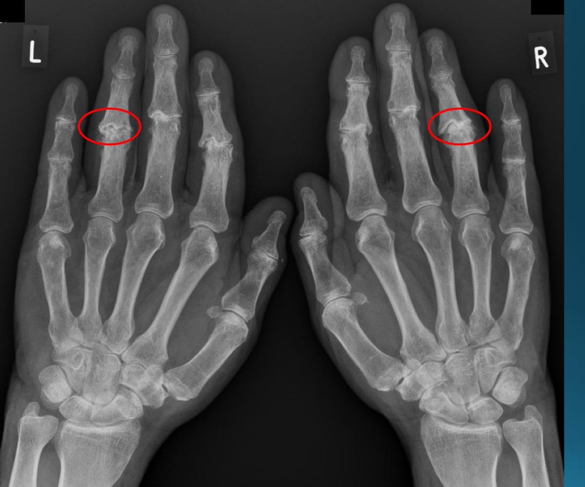 <p>waht are the features denoting erosive osteoarthritis on radiograph? </p>