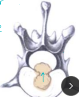 <p><span>Intervertebral Disk Disease</span></p>