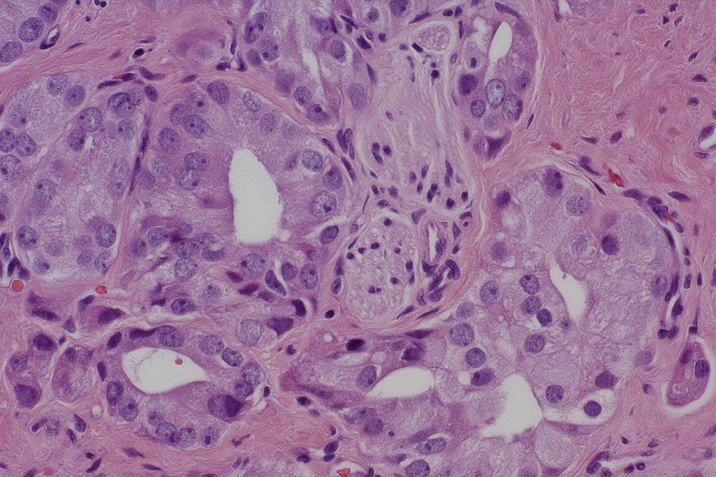 <p>A 45-year-old man comes to the physician for a routine health maintenance examination. On physical examination, there are no remarkable findings. Laboratory findings include serum creatinine, 1.1 mg/dL; urea nitrogen, 17 mg/ dL; glucose, 76 mg/dL; alkaline phosphatase, 89 U/L; and prostate-specific antigen (PSA), 16 ng/mL. Prostate biopsies are performed and the high power microscopic appearance of a biopsy specimen is shown in the figure. Which of the following is the most likely risk factor for his disease?</p>