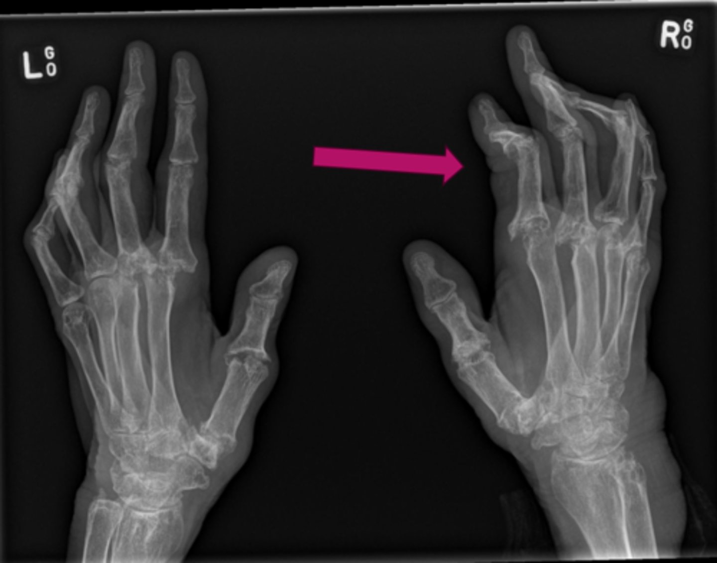 <p>What pathology is seen here?</p>