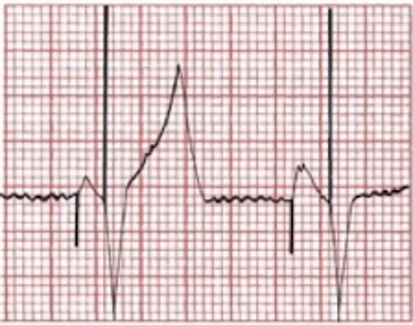 <p>-spike followed by P wave</p><p>-spike followed by wide/ bizarre QRS like LBBB</p>