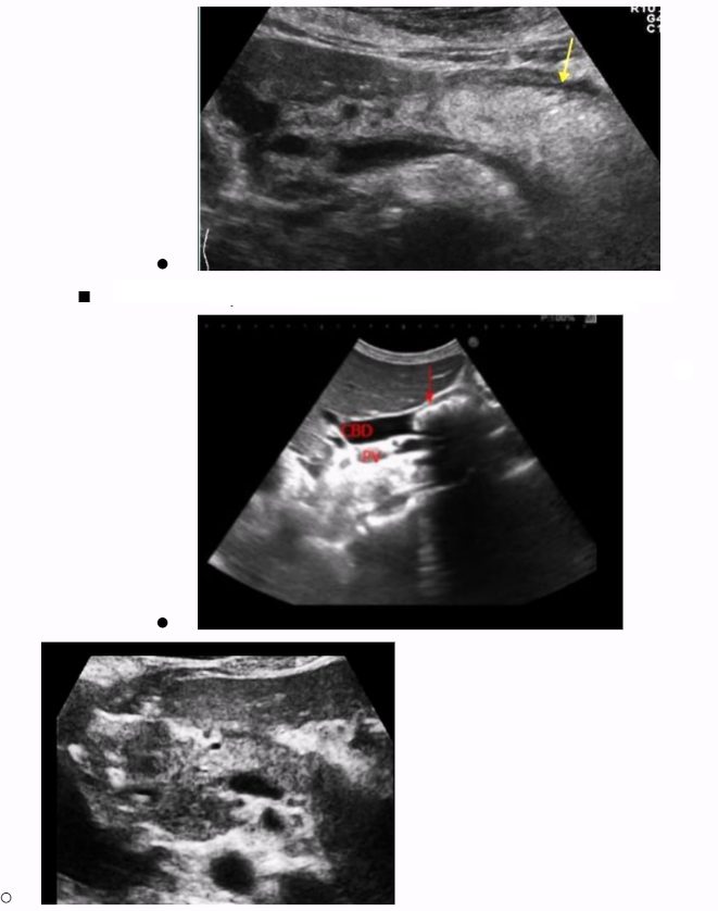 <ul><li><p><span style="background-color: transparent;">Many cases, pancreas can appear normal</span></p></li><li><p><span style="background-color: transparent;"><u>Diffuse/focal enlargement of pancreas</u></span></p><ul><li><p><span style="background-color: transparent;">Mainly seen on pancreatic head</span></p></li><li><p><span style="background-color: transparent;">More reliable indicator of disease</span></p></li></ul></li><li><p><span style="background-color: transparent;">Hypoechoic compared to chronic pancreatitis</span></p></li><li><p><span style="background-color: transparent;">Pancreatic edema or peripancreatic fluid</span></p></li><li><p><span style="background-color: transparent;">Dilation of pancreatic duct, mainly due to blockage (double barrel sign)</span></p></li></ul><p></p>