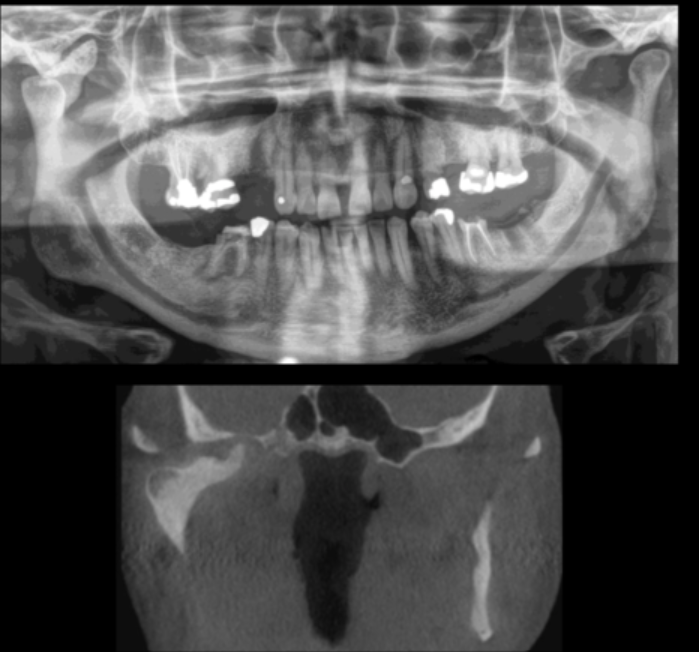 <p>place pin on r or l condyle </p>