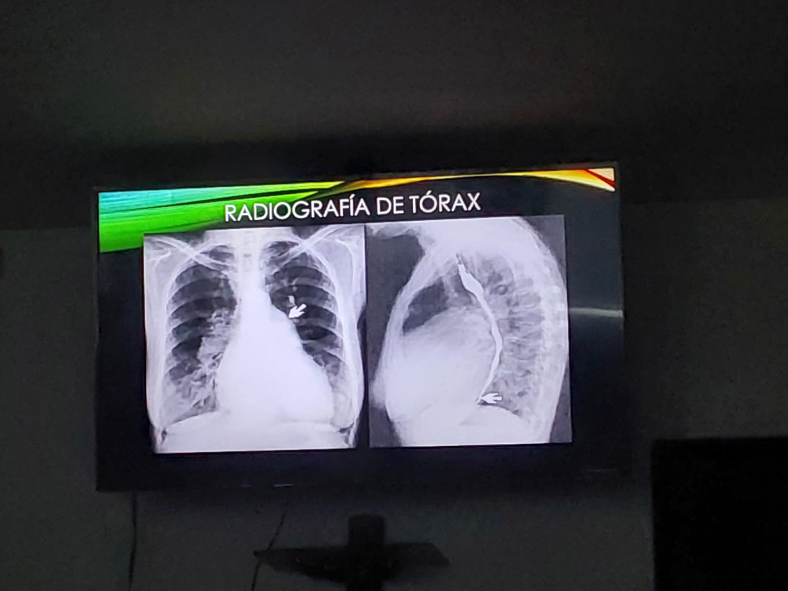 <p>Luego, de este mismo caso clínico, se realiza una radiografía posteroanterior de tórax como estudio complementario observando dilatación específica de una cámara cardíaca. ¿Cuál es la estructura señalada en la flecha en la imagen a la izquierda?</p>