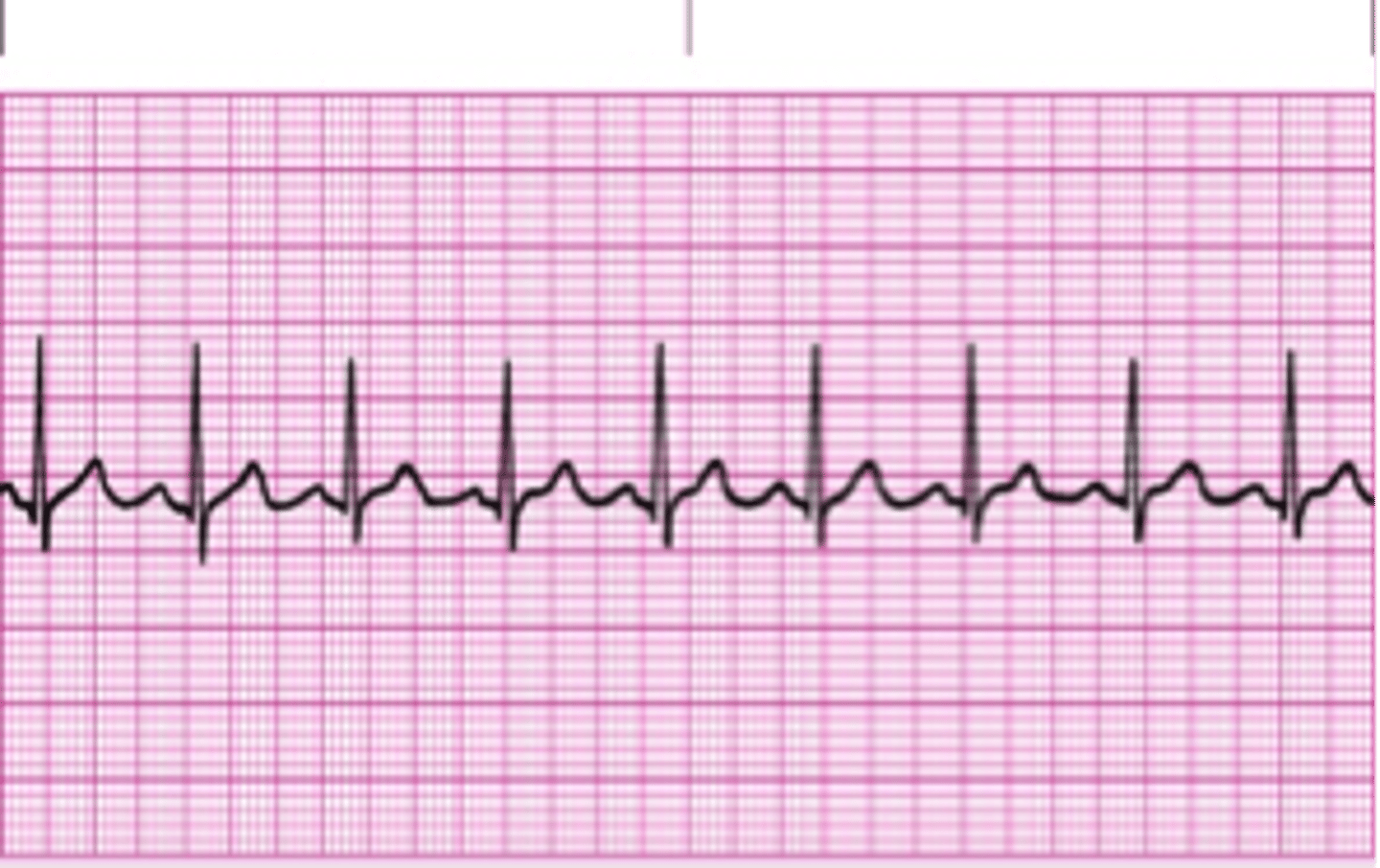 <p>This is a ___________________________Rhythm</p><p>HR:60-100 normal</p><p>QRS complex 0.04-.12</p><p>PR interval 0.12-0.2</p><p>QT interval 0.40-0.44</p>