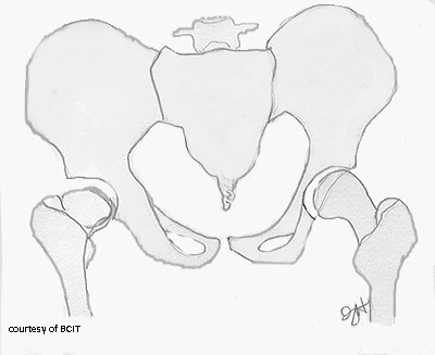 <p>At the base of the femoral neck, near the trochanters.</p>