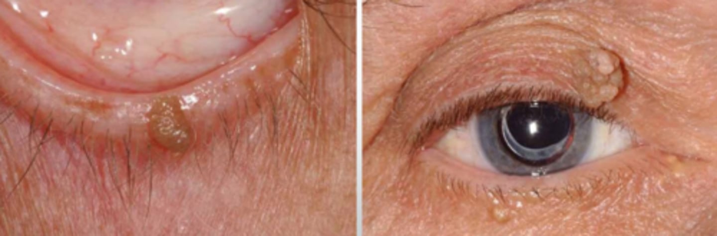 <p>over-growth of squamous epithelium = often pedunculated (on a stalk, skin tag) or may be sessile (flat)</p>