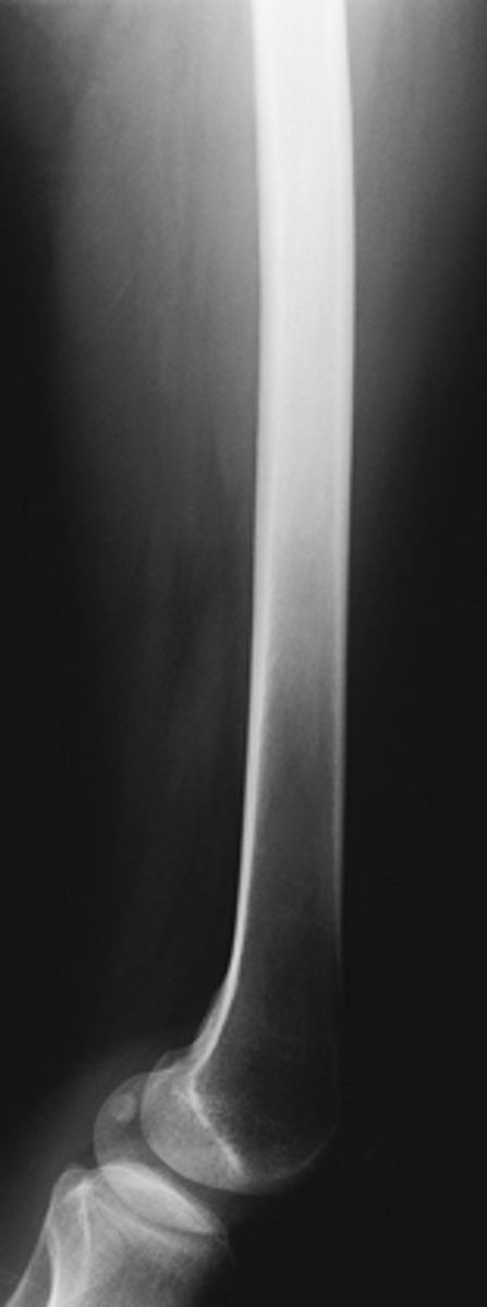 <p>- True lateral</p><p>- Mediolateral</p><p>- CR to midpoint of IR</p><p>- Knee joint included (minimum)</p><p>- No rotation, knee will appear tilted, this is normal. That's why we angle on a lateral knee.</p><p>- Include knee joint up as high as will fit on the IR.</p>