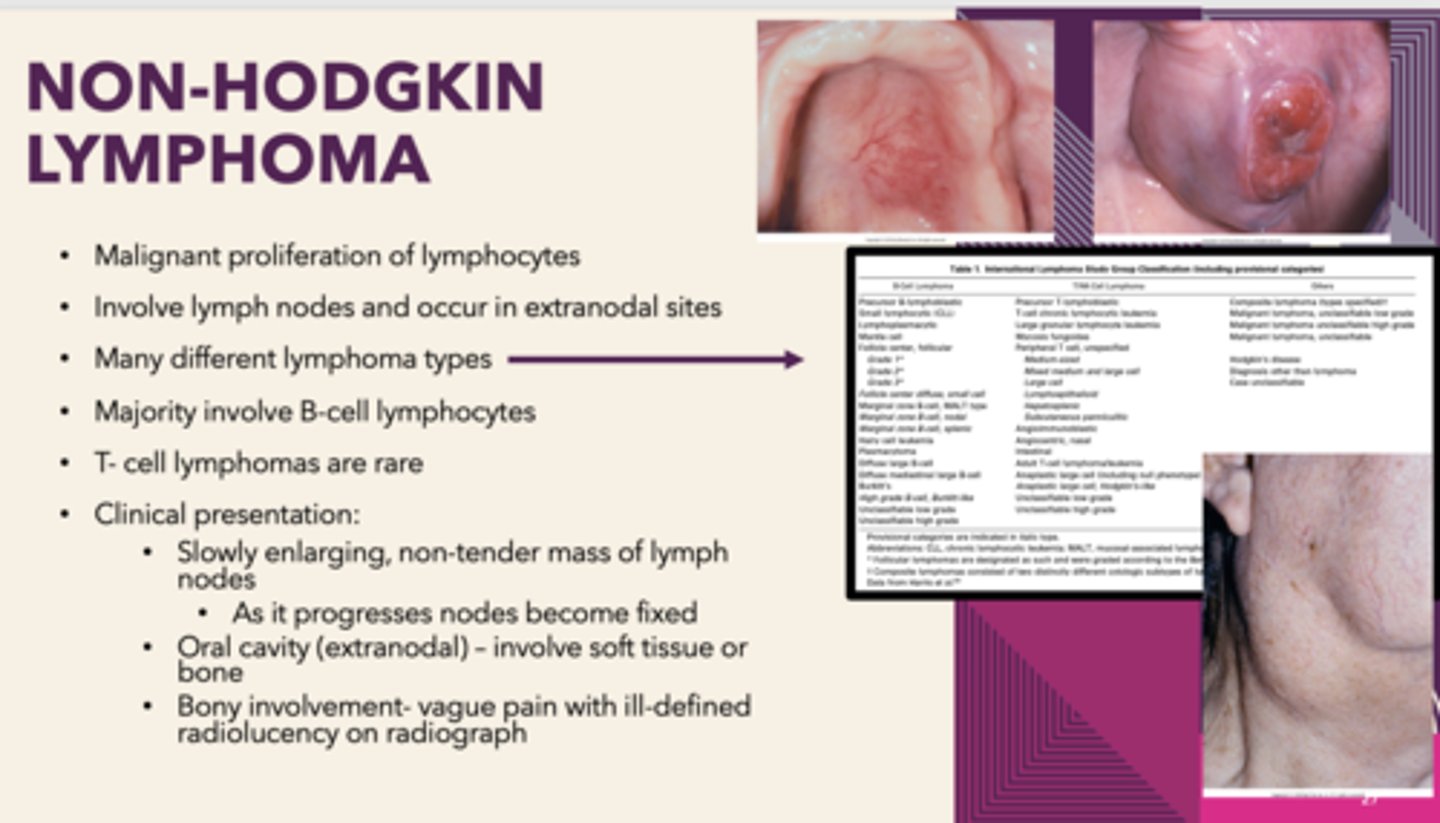 <p>Non-Hodgkin's Lymphoma</p>