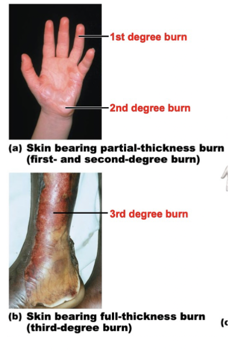 <p>1st Degree Burn</p><ul><li><p>Upper epidermis is damaged</p></li></ul><p></p><p>2nd Degree Burn</p><ul><li><p>Epidermis and superficial region of dermis is also damaged<br>- Blisters appear<br>- Skin heals with little scarring</p></li></ul><p></p><p>3rd Degree Burn</p><ul><li><p>Consumes entire thickness of the skin (Both epidermis and dermis are affected)<br>- Burned area appears white, red, or blackened <br>- Graft is needed</p></li></ul><p></p><p>Serious burns are life-threatening because it can lead to a<strong> catastrophic loss of body fluids</strong></p><ul><li><p>Can lead to fatal circulatory shock</p></li><li><p>After the initial crisis,<strong> infection</strong>&nbsp;becomes the main threat<br>- Pathogens can easily pass through the skin</p></li></ul><p></p><ul><li><p><strong>Rule of Nines</strong>&nbsp;help estimate the extent of the burn</p></li></ul><p></p>