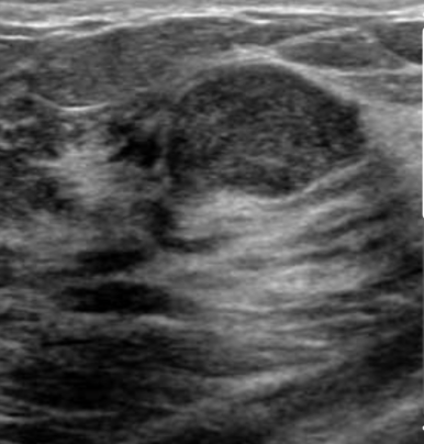 <p>Fibroademona </p>