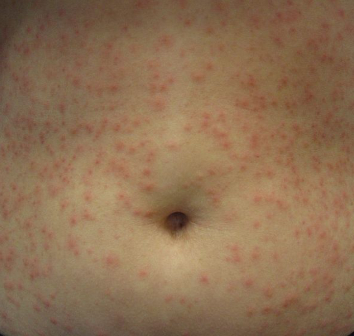 <p>Topical antibiotics and chlorhexidine scrub </p><p></p>