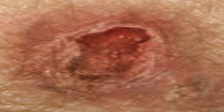 <p>Begins in the squamous epidermis; slow-growing red bump or ulcer.</p>