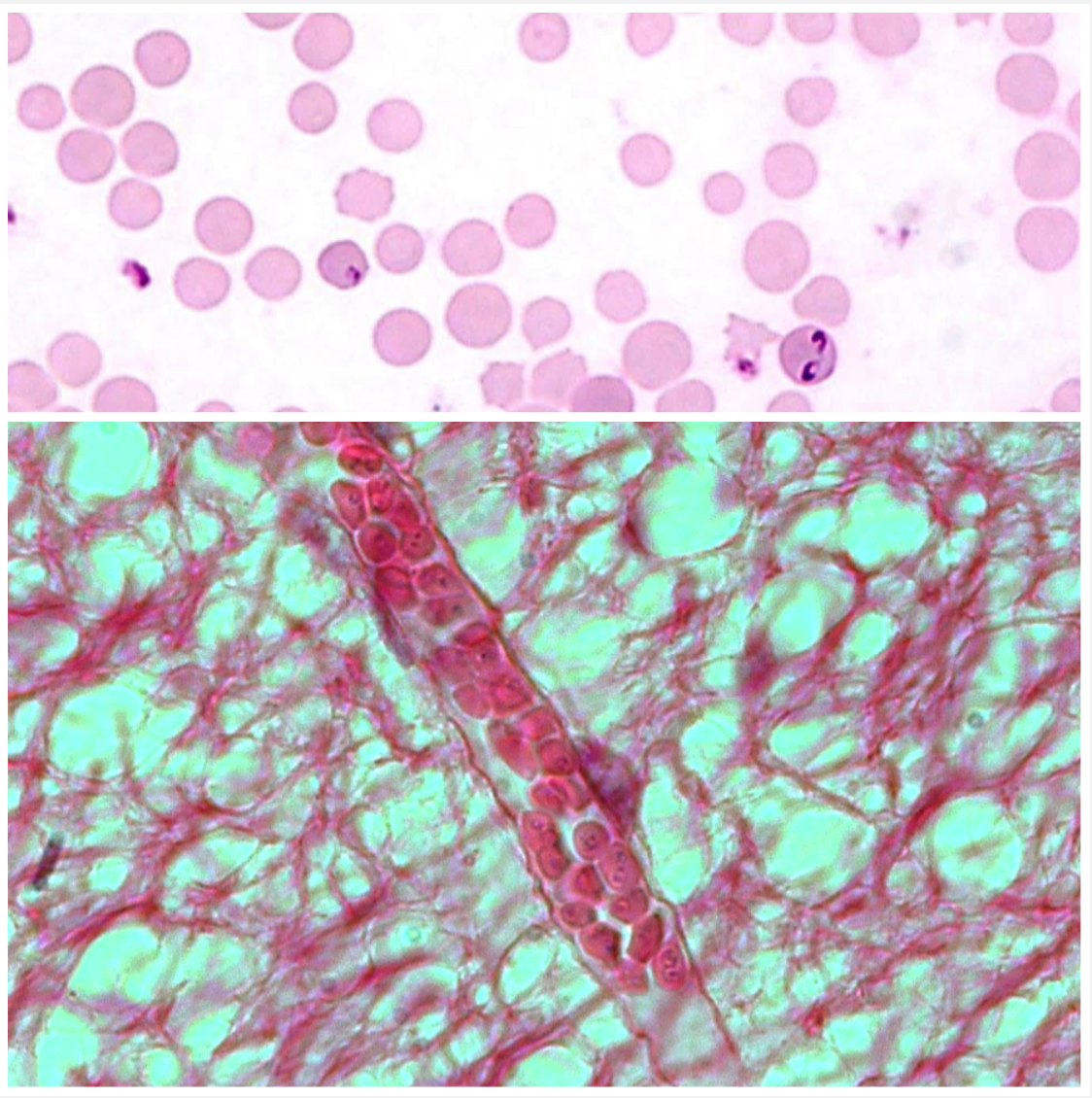 <p>RED BLOOD CELLS You have cows with inappetence, depression, convulsions, paralysis, aggression, ataxia, anemia, haemoglobinuria and jaundice.</p><ul><li><p>Ingestion of sporozoites from ticks with their saliva</p></li><li><p>Clogs capillaries, ishcaemia in brain, neurological signs unlike babesia bigemina</p></li></ul>