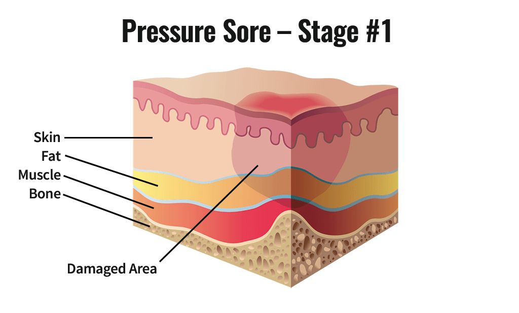 <p>Stage 1 Pressure Injury</p>