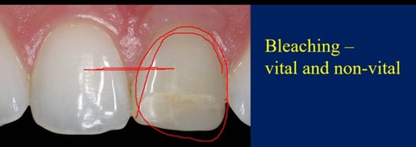 <p>a non-vital tooth even if it has a history of successful endodontic treatment. Bleaching can bring base shade closer to the adjacent tooth prior to placement of a veneer,.</p><p>Can also be done with a partial veneer to bring surrounding tooth structure closer to what will be the placed partial veneer</p>