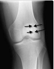 <p>What plane is this fracture in?</p><p>-This type of fracture is really only seen in the patella </p>