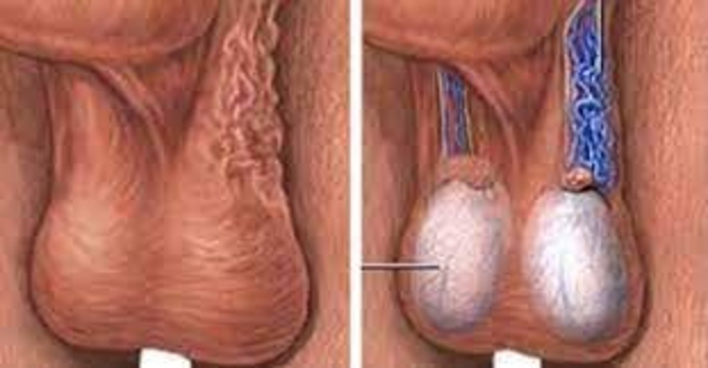 <p>Dilation of the pampiniform venous plexus and internal spermatic vein in the scrotum.</p>