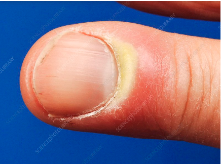 <p>fluctuant swelling beneath entire nail plate</p>