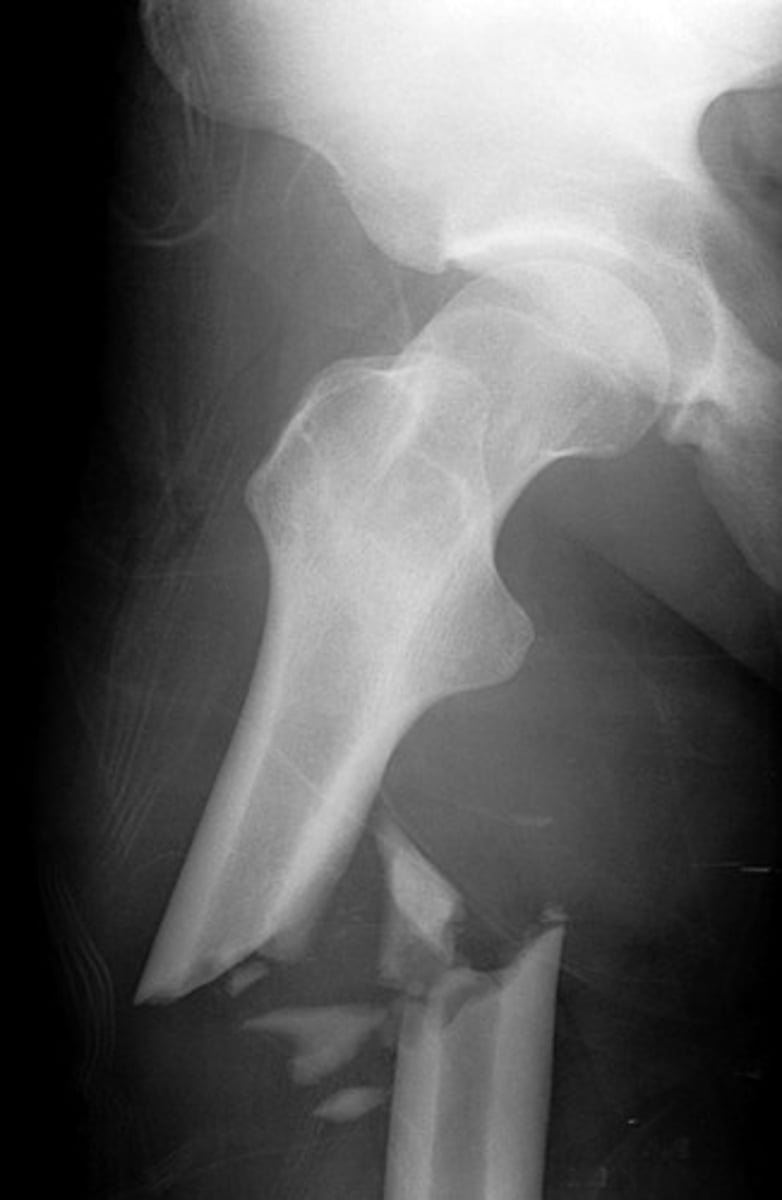 <p>crack or break in a bone</p>