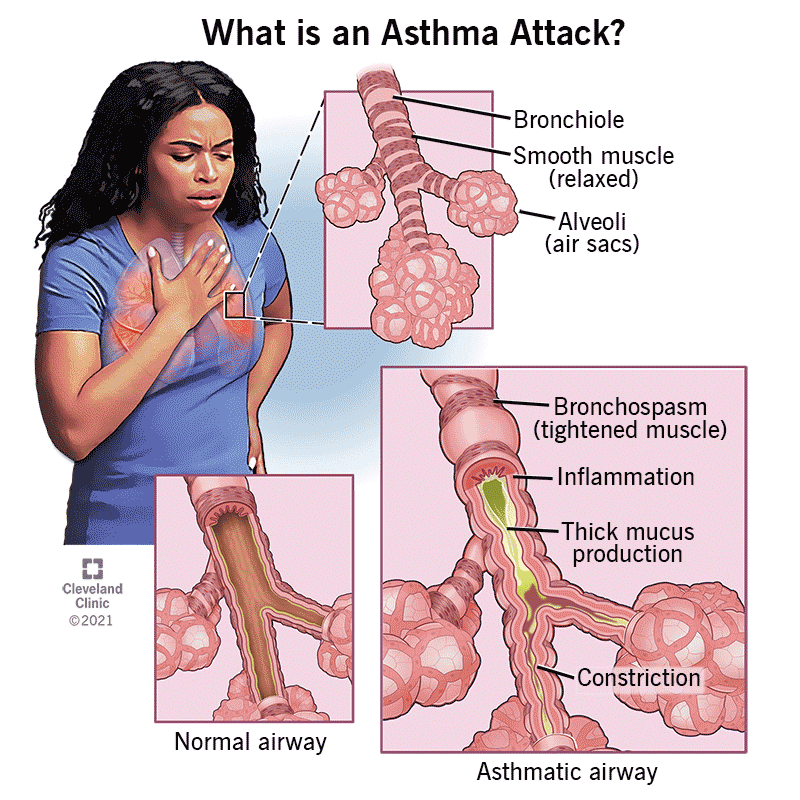 <ul><li><p>Chronic lung disease</p></li><li><p>Affects all ages</p></li><li><p>Caused by inflammation and muscle tightening around the airways, making it harder to breathe. A person's airways become inflamed, narrow, and swell, and produce extra mucus, which makes it difficult to breathe</p></li><li><p>Symptoms can include coughing, wheezing, shortness of breath and chest tightness. These symptoms can be mild or severe and can come and go over time</p></li><li><p>Can flare up due to overactivity</p></li></ul>