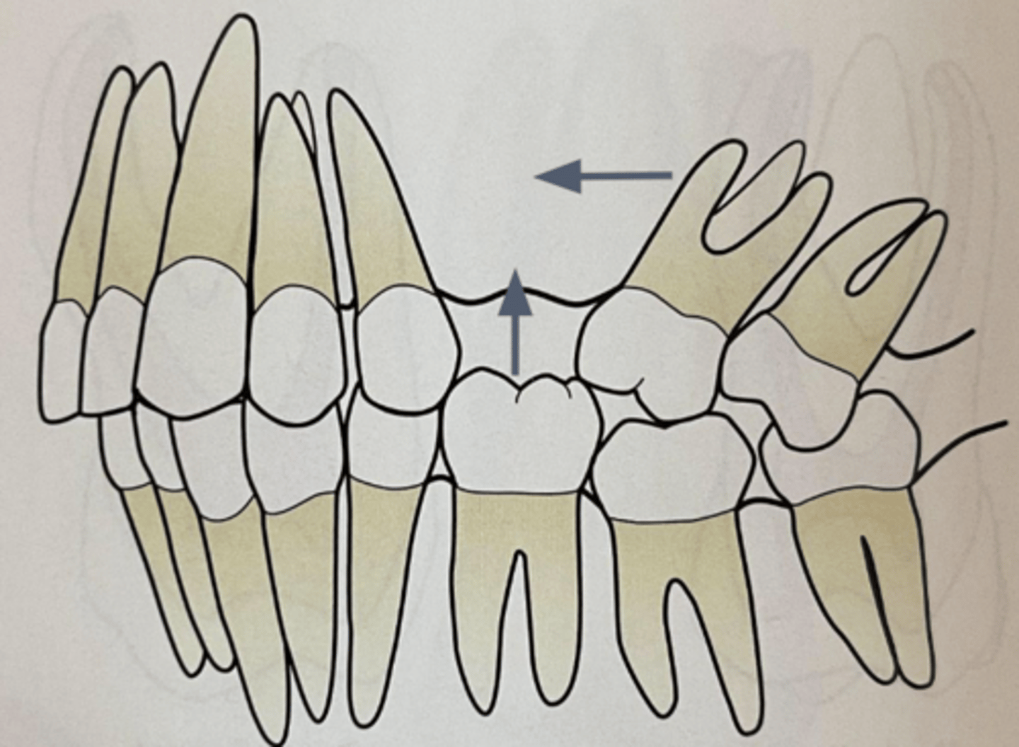 <p>if Mx 1st molar is lost, there is mesial drift of Mx 2nd molar and super-eruption of Md 1st molar to fill that space</p>