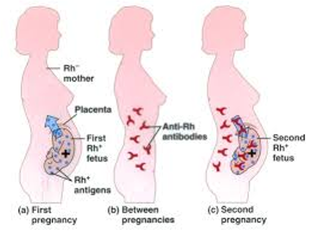 <p>What does this refer to</p><ul><li><p><span style="color: red;">Methotrexate Indications</span></p><ul><li><p><span style="color: red;">Early gestation</span></p></li><li><p><span style="color: red;">Gestational sac &lt; 4cm</span></p></li><li><p><span style="color: red;">B-HCG &lt; 5000</span></p></li><li><p><span style="color: red;">No FHT</span></p></li></ul></li><li><p>Compliant F/U (serial <span style="color: red;">B-hCG</span> )</p></li><li><p>Must be immunocompetent</p></li><li><p>Alternative tx</p><ul><li><p><span style="color: red;">Laparoscopic salpingostomy</span>  if patient d<span style="color: red;">oes not meet criteria for medical management </span>OR</p></li><li><p>Salpingectomy</p></li></ul></li><li><p><span style="color: red;">Rhogam if Rh negative</span></p></li></ul><p></p>
