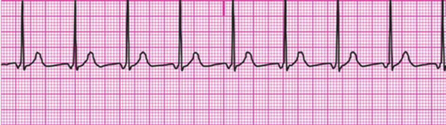 <p>Accelerated junctional rhythm</p>