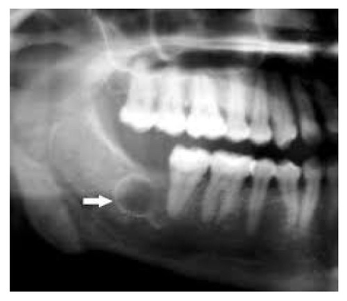 <p>This cyst develops in place of a tooth. Most commonly in place of a 3rd molar. Most often seen in young adults and discovered on radiographic exam. Tx: surgical removal.</p>