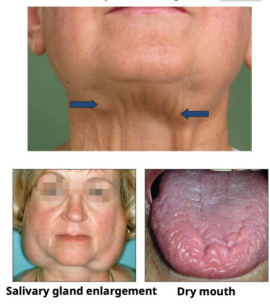 <p>What is the gender predilection and age range for Sjogren Syndrome?</p>