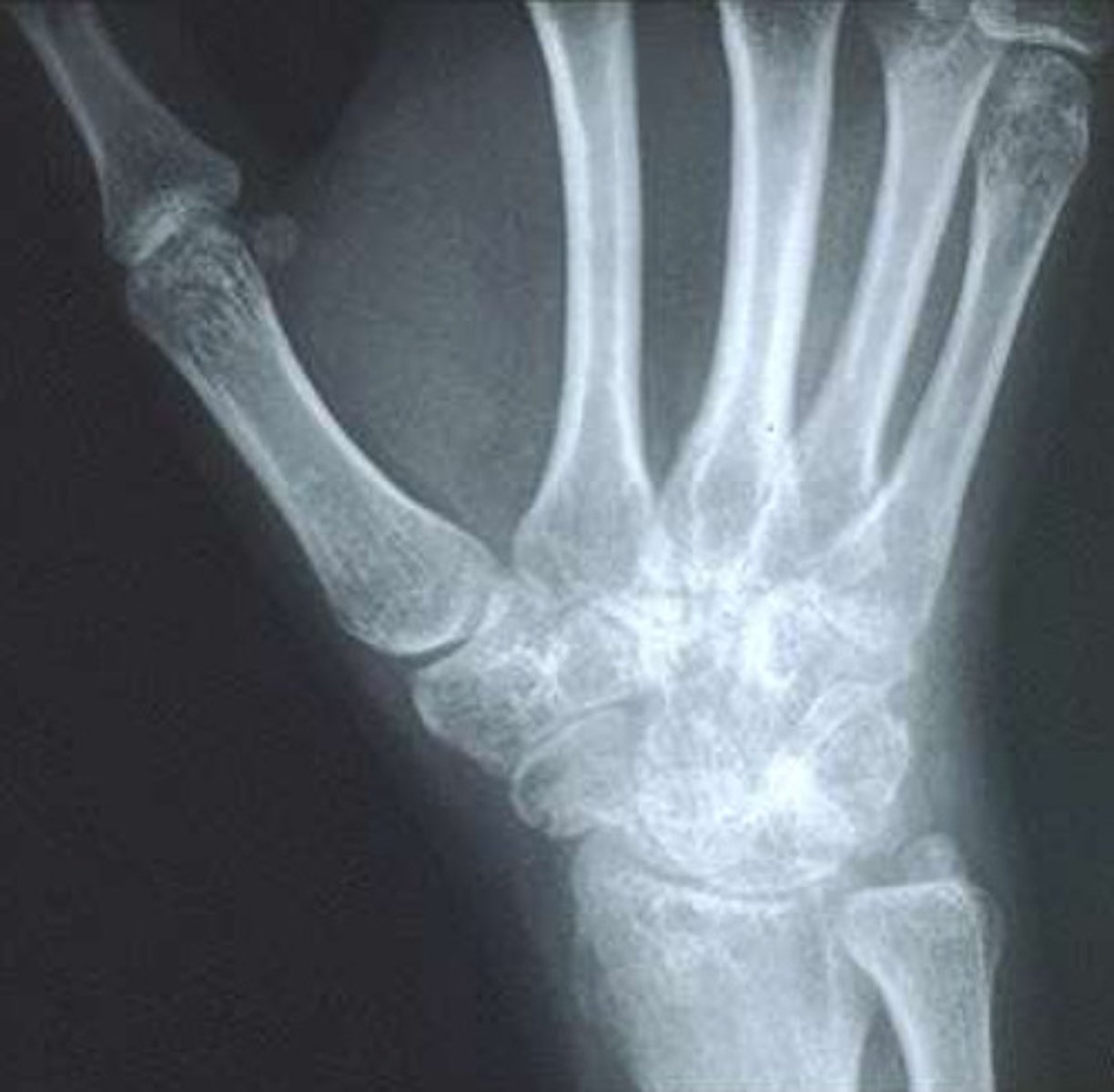 <p>Soft tissue swelling</p><p>Osteopenia</p><p>Loss of joint space</p><p>Articular erosions</p><p>Malalignments/subluxations</p><p>Are all radiographic findings of what?</p>