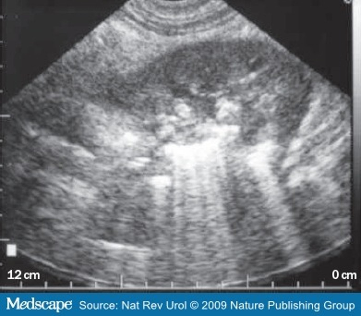 <p>1. A severe, necrotizing infection of the renal parenchyma</p><p>2. Air is infiltrated which causes bacteria growth</p>