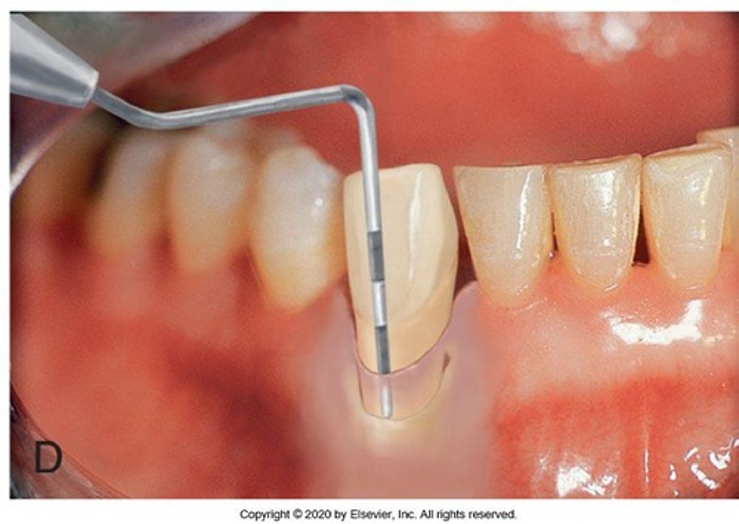 <p>The distance from the gingival margin to the base of the periodontal pocket.</p>
